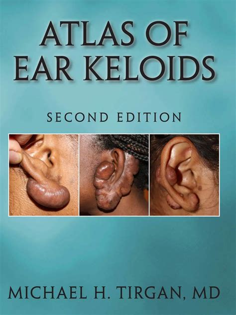 Atlas of Ear Keloids - keloids information guide by Dr. Tirgan