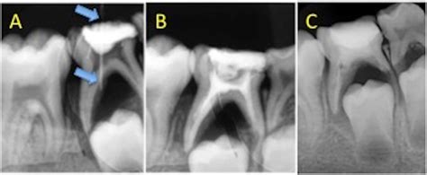 Primary molar with chronic periapical abscess showing atypical ...