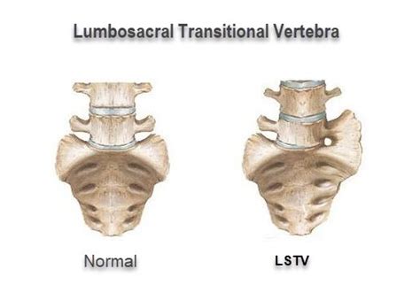 Dissatisfied Hip Arthroscopy Patients? Might be Lumbosacral ...