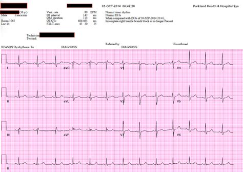 Printable Ekg Strips