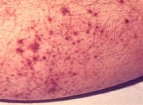 Petechiae Pictures, Causes, Symptoms, Diagnosis and Treatment ...