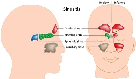 Great Tips About How To Fight A Sinus Infection Without Antibiotics ...