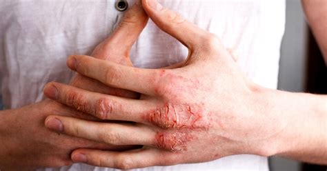 Do You Have Hand Eczema? Study Shows Dish Soap Could Be to Blame