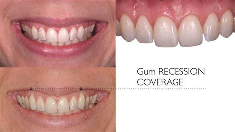 Gum Grafts - dental implants Glenview IL - Glen Perio - Dr. Joshua Hassan