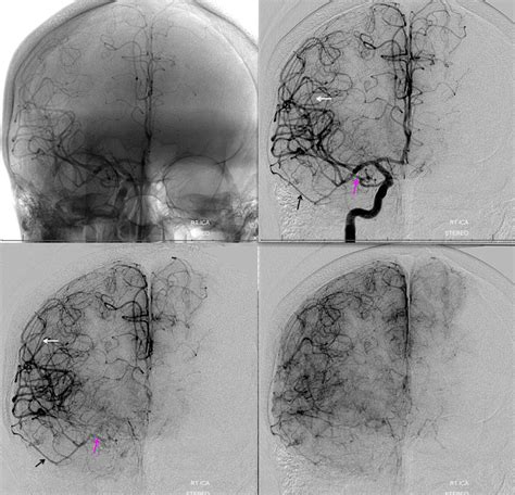 Middle Meningeal Artery | neuroangio.org