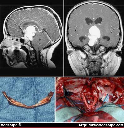 CT and MRI Blog: Craniopharyngioma