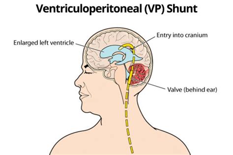 Hydrocephalus and Shunts | Ausmed