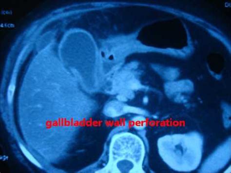 GALLBLADDER PERFORATION- CECT Findings. How to diagnose and manage ...