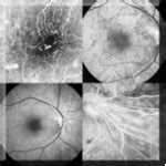 Fluorescein Angiography | Department of Ophthalmology