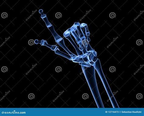 X-ray Hand - Arthritis Stock Photos - Image: 12716473