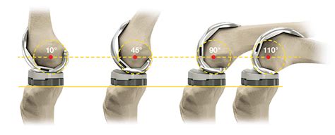 Total Knee Replacement Implants | Stryker