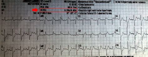 candlelightmedic: QT Interval