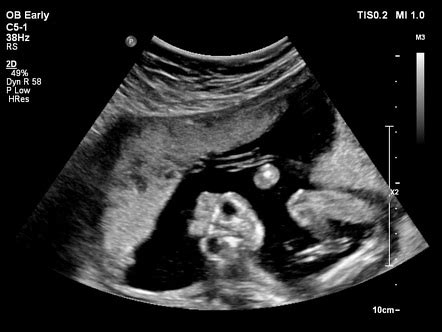 Anencephaly Ultrasound Findings