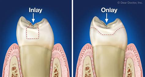 Inlays & Onlays | Dominick J. Pisciotta, D.D.S. | Alexandria Virginia