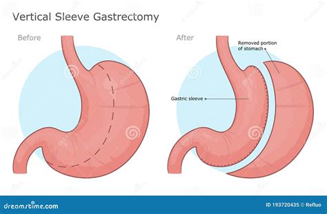 Gastric Sleeve Resection. Vertical Stomach Reduction Bypass, Operation ...