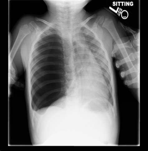 X- Ray Diagnostics Of Pneumothorax: Radiographic Representations Of The ...