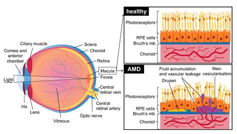 Macular Degeneration Drusen