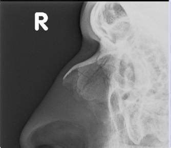 Nasal Bone Fracture X Ray