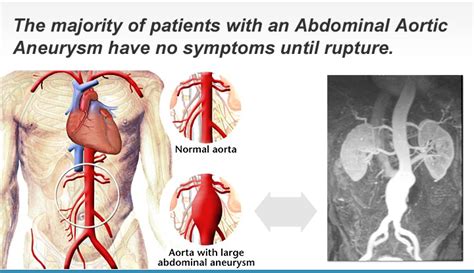 Abdominal Aortic Aneurysm Screening | Prevention