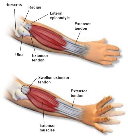 Lateral Epicondylitis | Central Coast Orthopedic Medical Group