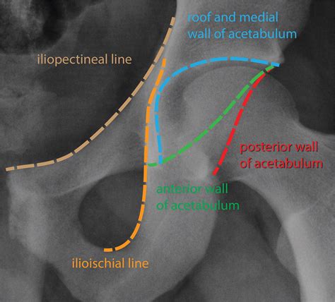 Traumatic Hip Dislocation: What the Orthopedic Surgeon Wants to Know ...