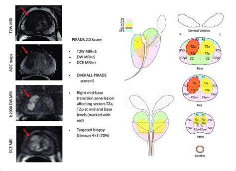 Sample multiparametric MRI PIRADS evaluation of a 62-year old male with ...