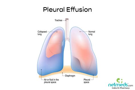 Lung Cancer Pleural Effusion