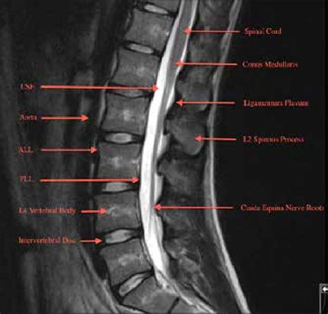 Normal Lumbar Mri Images