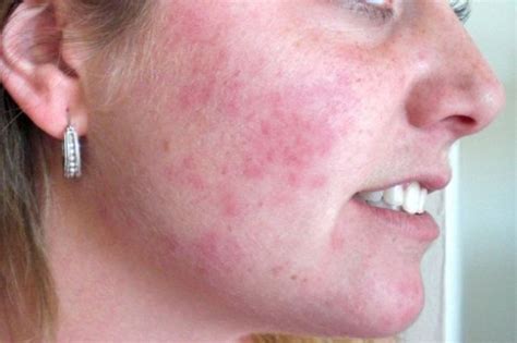 A Symptom of sensitivity | Face rash remedies, Rashes remedies, Rash on ...