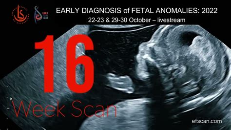 16 Week Anomaly Scan - EARLY DIAGNOSIS of FETAL ANOMALIES 2022 - YouTube