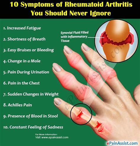 10 Symptoms of Rheumatoid Arthritis You Should Never Ignore ...