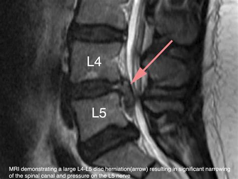 Herniated Lumbar Disc by Kris B. Siemionow, MD - Leading Expert in ...