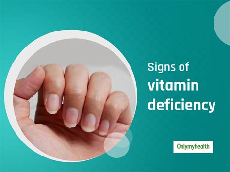 Vitamin D Deficiency Symptoms - FAQs