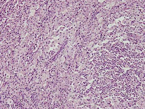 Histology of the tubo-ovarian masses shows sheets of foamy macrophages ...