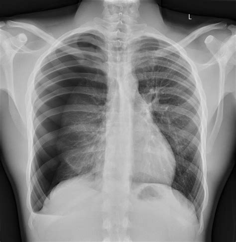 Pneumothorax Chest X Ray