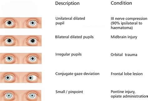 Pupil Size Chart Normal Range