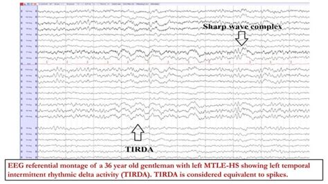 Abnormal focal eeg patterns