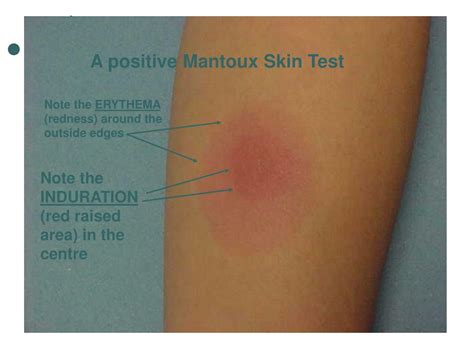 Bruise positive bruise normal negative tb test pictures - riloja