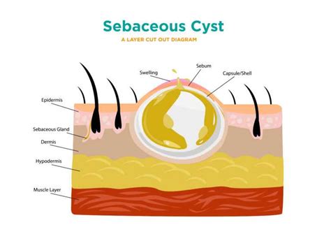 Sebaceous Cyst Removal