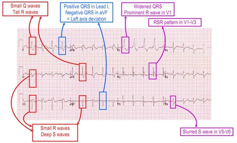 Bifascicular and trifascicular block | Deranged Physiology