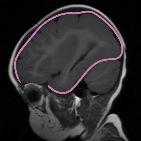 Neuroanatomy Glossary: Lissencephaly | Draw It to Know It