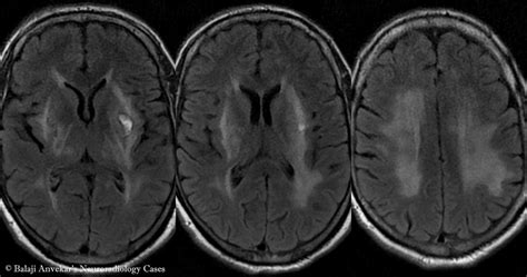 Dr Balaji Anvekar FRCR: Chronic Hypertensive Encephalopathy MRI