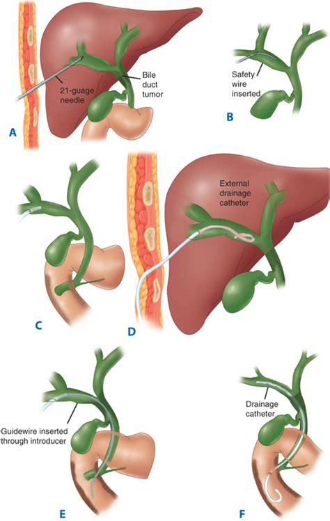 Percutaneous Transhepatic Drainage Of Gallbladder - Best Drain Photos ...