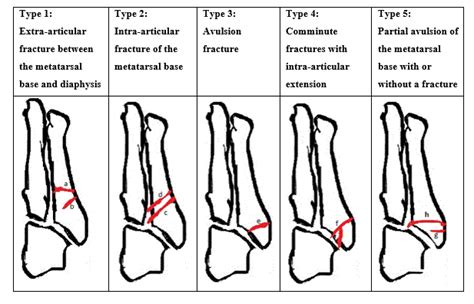 Metatarsal Bone Fracture