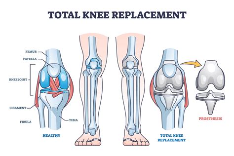 Types Of Knee Surgery Types Of Knee Replacement Health City | Hot Sex ...