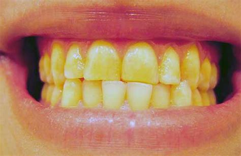 Stained Teeth Causes & How You Can Avoid Them - Dentistry by Dr ...