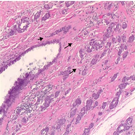 Invasive Ductal Carcinoma