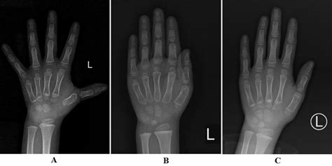 Improvement of bone age after GH treatment. A: The bone age was 3.8 ...