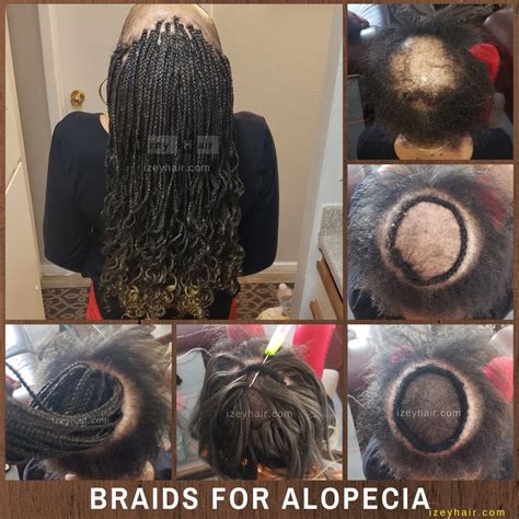 Braids for Alopecia