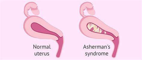 Asherman's Syndrome - Grading, Symptoms, Causes & Fertility